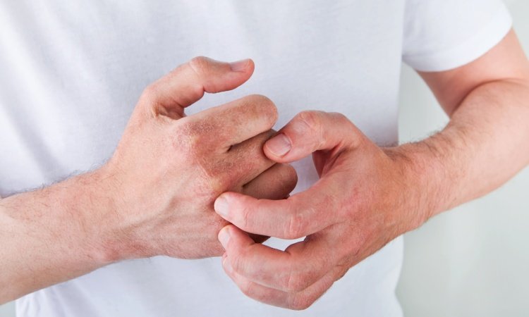 Nahaufnahme von den Händen eines Mannes, welcher sich mit einer Hand an den trockenen Knöcheln der anderen Hand juckt